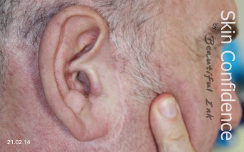 Face lift scar